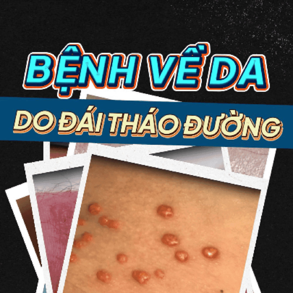 Nhận biết các bệnh da do đái tháo đường