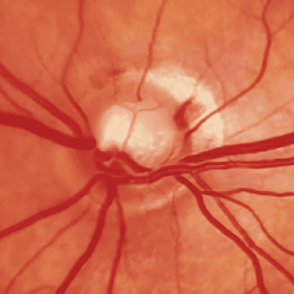 Biến chứng mạn tính mạch máu nhỏ (vi mạch): Những tổn thương âm thầm