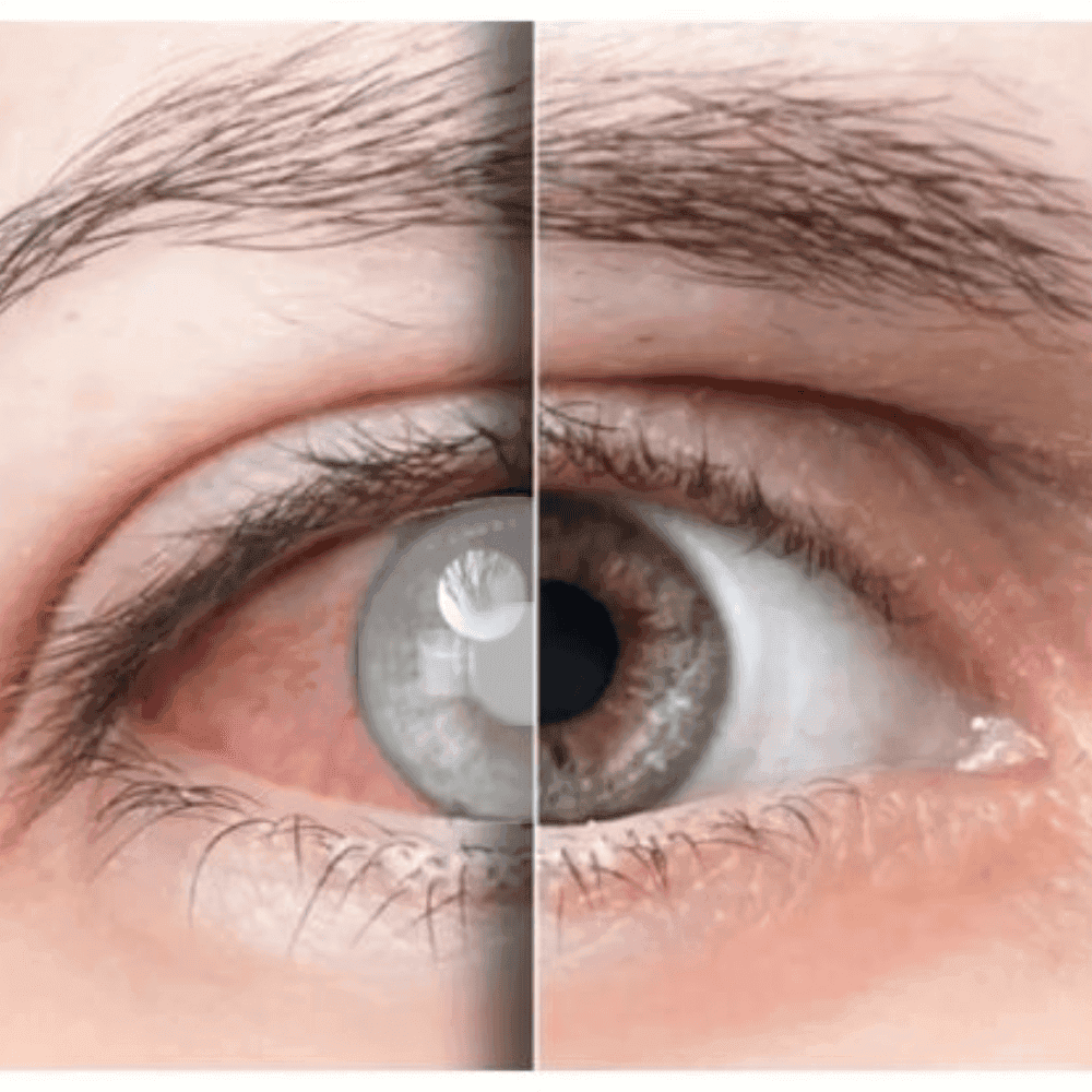 Biến chứng mạn tính ở mắt: Nguy cơ mù lòa do đái tháo đường